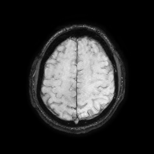 Cerebral cavernous venous malformation (Zabramski type II) (Radiopaedia 85511-101198 Axial SWI 93).jpg