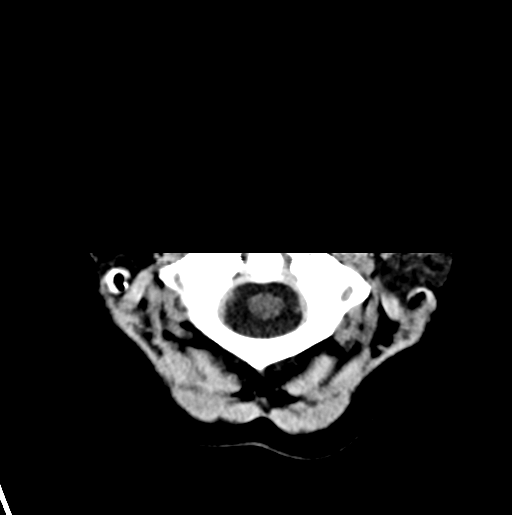 File:Cerebral cavernous venous malformations (Radiopaedia 48117-52945 Axial non-contrast 2).png