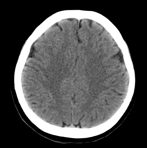 File:Cerebral cavernous venous malformations (Radiopaedia 48117-52945 Axial non-contrast 23).png