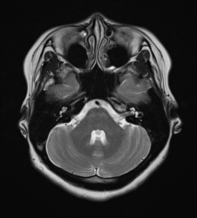 File:Cerebral cavernous venous malformations (Radiopaedia 48117-52946 Axial T2 6).png