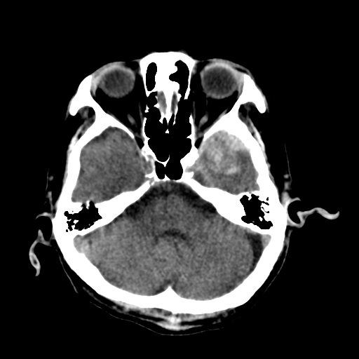File:Cerebral contusions, subarachnoid hemorrhage and subdural hygromas (Radiopaedia 55399-61827 Axial non-contrast 11).png