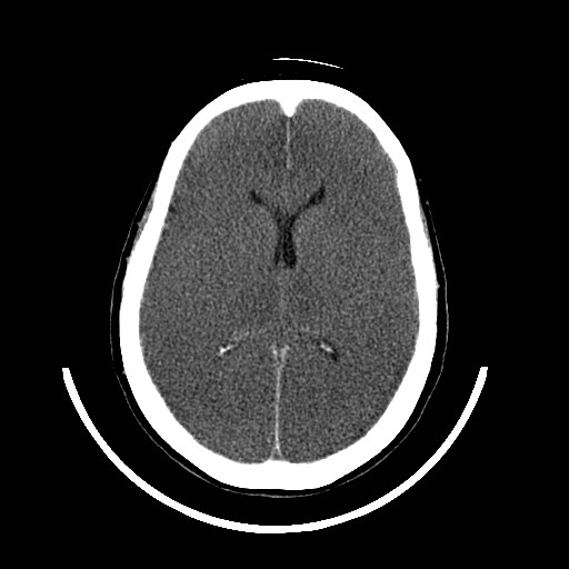 File:Cerebral edema (evolution in time) (Radiopaedia 19418-19439 non-contrast 55).jpg