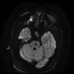Cerebral embolic infarcts (embolic shower) (Radiopaedia 49837-55108 Axial DWI 82).jpg