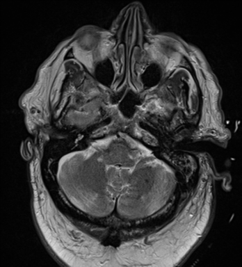 File:Cerebral embolic infarcts (embolic shower) (Radiopaedia 57395-64342 Axial T2 9).png