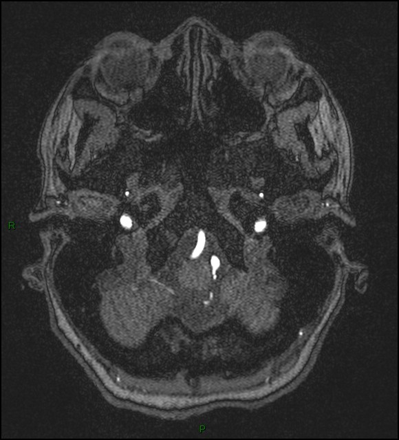 Cerebral fat embolism (Radiopaedia 35022-36525 Axial TOF 22).jpg