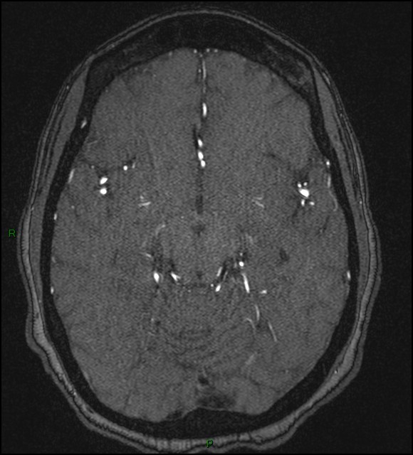 Cerebral fat embolism (Radiopaedia 35022-36525 Axial TOF 86).jpg