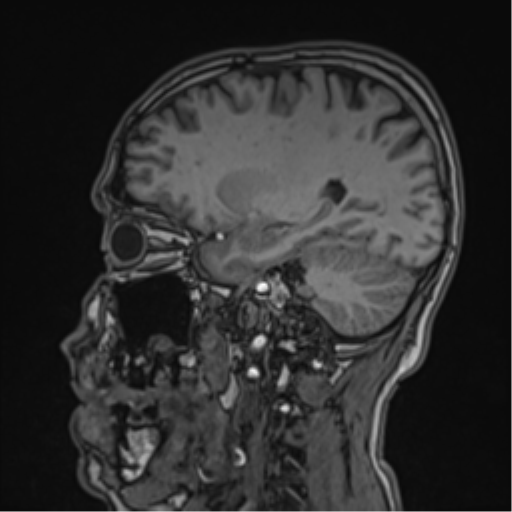 Cerebral fat embolism (Radiopaedia 57697-64639 Sagittal T1 33).png