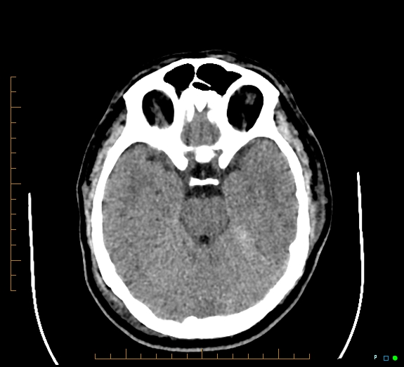Cerebral fat embolism (Radiopaedia 85521-101220 Axial non-contrast 25).jpg