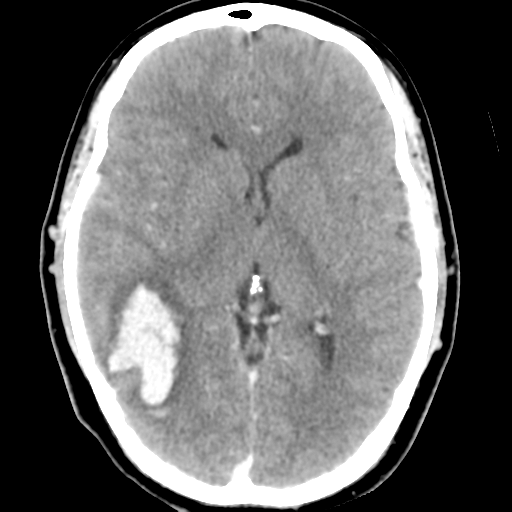 Cerebral hemorrhage secondary to arteriovenous malformation (Radiopaedia 33497-34561 B 27).png