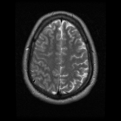 File:Cerebral hemorrhage secondary to arteriovenous malformation (Radiopaedia 33497-34572 Axial T2 19).png