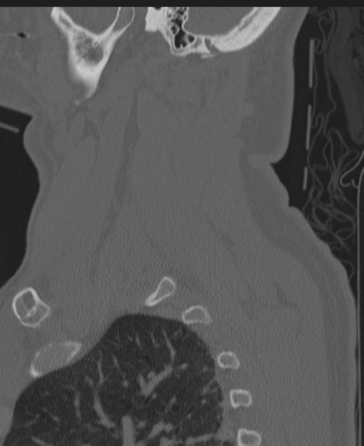 Cerebral hemorrhagic contusions and cervical spine fractures (Radiopaedia 32865-33841 Sagittal bone window 83).jpg