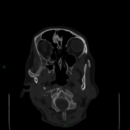 Cerebral metastases - breast primary (Radiopaedia 77653-89857 Axial bone window 8).jpg