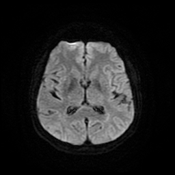 Cerebral metastases - melanoma (Radiopaedia 80972-94522 Axial DWI 17).jpg