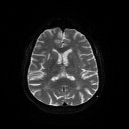 Cerebral metastases - melanoma (Radiopaedia 80972-94522 Axial DWI 82).jpg