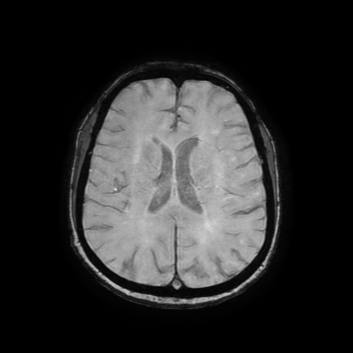 File:Cerebral metastases - melanoma (Radiopaedia 80972-94522 Axial SWI 61).jpg