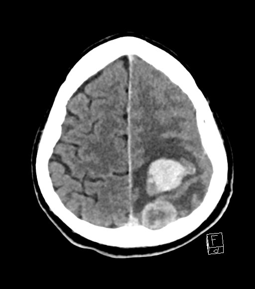 Cerebral metastases - testicular choriocarcinoma (Radiopaedia 84486-99855 Axial C+ delayed 15).jpg
