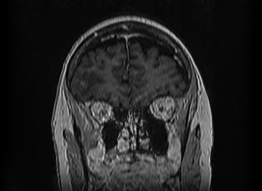 Cerebral metastases from lung cancer with amyloid angiopathy and cerebellopontine angle meningioma (Radiopaedia 74306-85191 Coronal T1 C+ 12).jpg