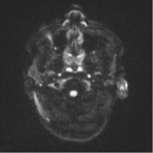 Cerebral metastases mimicking abscesses (Radiopaedia 45841-50131 Axial DWI 30).png