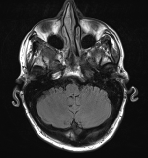 File:Cerebral metastasis - melanoma (Radiopaedia 54718-60954 Axial FLAIR 7).png