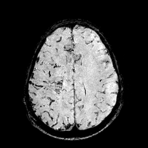 Cerebral parenchymal arteriovenous malformation (Radiopaedia 27280-27456 Axial SWI 86).jpg