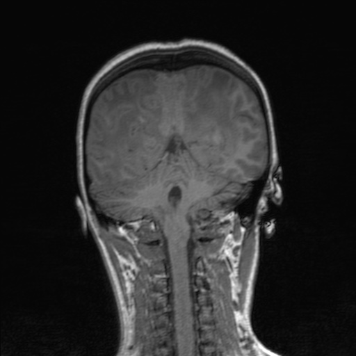 Cerebral tuberculosis with dural sinus invasion (Radiopaedia 60353-68090 Coronal T1 130).jpg