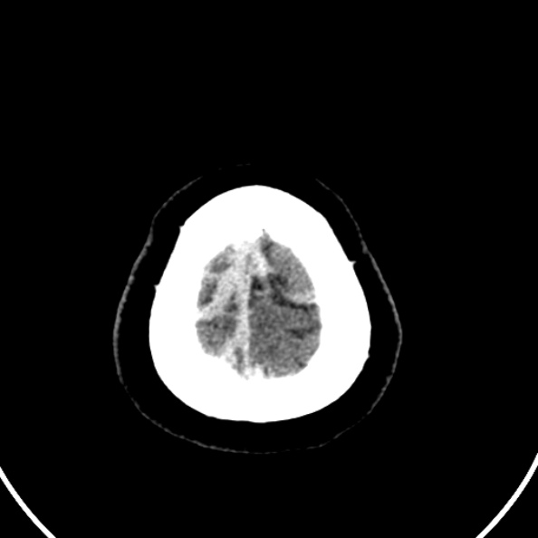 Cerebral venous hemorrhagic infarct from venous sinus thrombosis (Radiopaedia 55433-61883 Axial C+ delayed 13).jpg