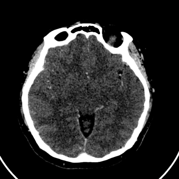 File:Cerebral venous hemorrhagic infarct from venous sinus thrombosis (Radiopaedia 55433-61883 Axial C+ delayed 85).jpg