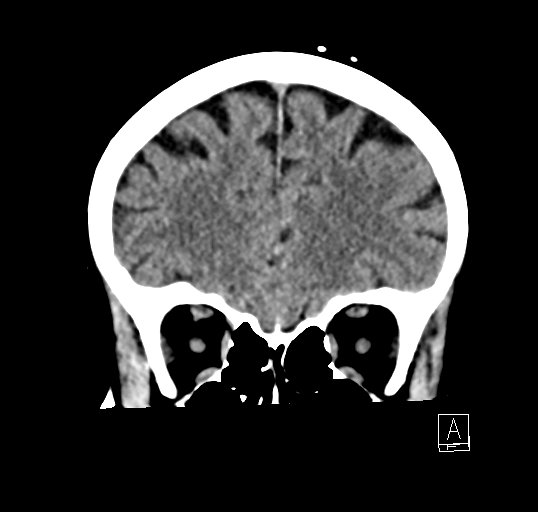 Cerebral venous infarction with hemorrhage (Radiopaedia 65343-74381 Coronal non-contrast 11).jpg