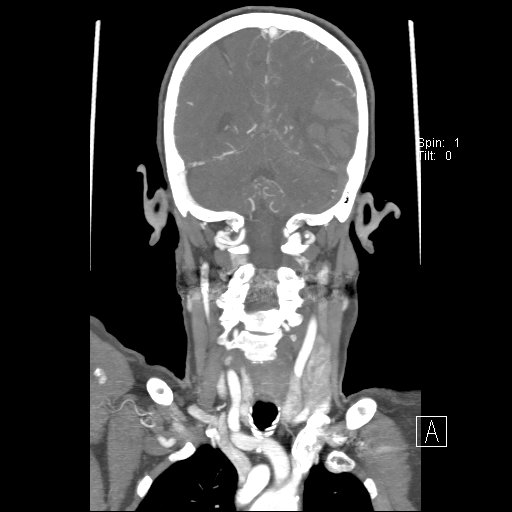 Cerebral venous infarction with hemorrhage (Radiopaedia 65343-74396 B 198).jpg