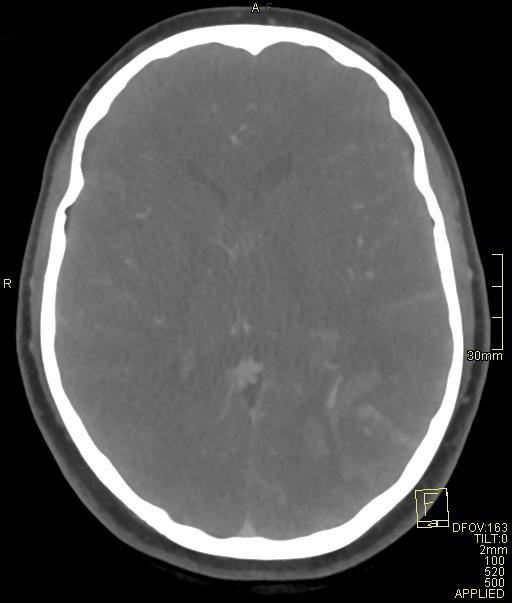 Cerebral venous sinus thrombosis (Radiopaedia 91329-108965 Axial venogram 44).jpg