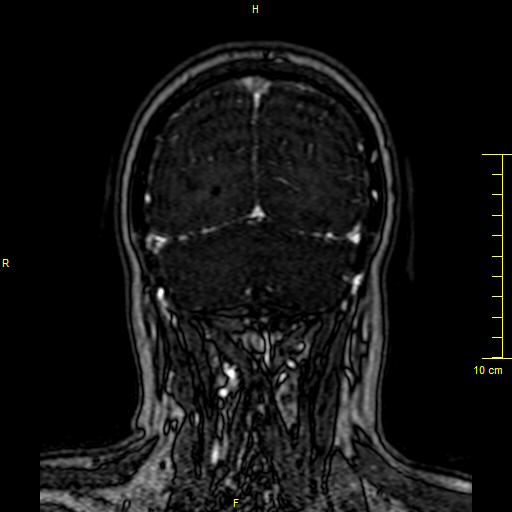 File:Cerebral venous thrombosis (Radiopaedia 23288-23351 MRV 142).JPG