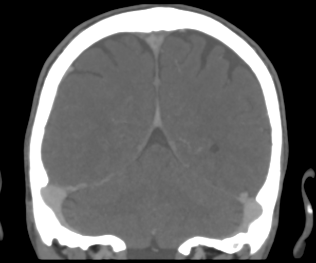 Cerebral venous thrombosis (Radiopaedia 38392-40467 Coronal CTA-Venogram 46).png
