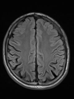 File:Cerebral venous thrombosis (Radiopaedia 38392-40469 Axial FLAIR 17).png