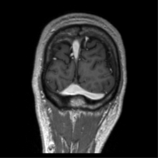 Cerebral venous thrombosis (Radiopaedia 38392-40469 Coronal T1 C+ 9).png
