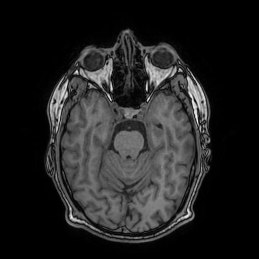 Cerebral venous thrombosis with secondary intracranial hypertension (Radiopaedia 89842-106957 Axial T1 71).jpg