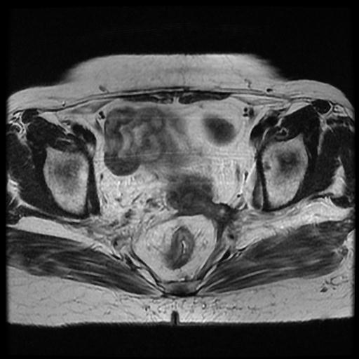 File:Cervical carcinoma (Radiopaedia 70924-81132 Axial T2 8).jpg