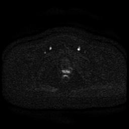Cervical carcinoma (Radiopaedia 85405-101028 Axial DWI 44).jpg