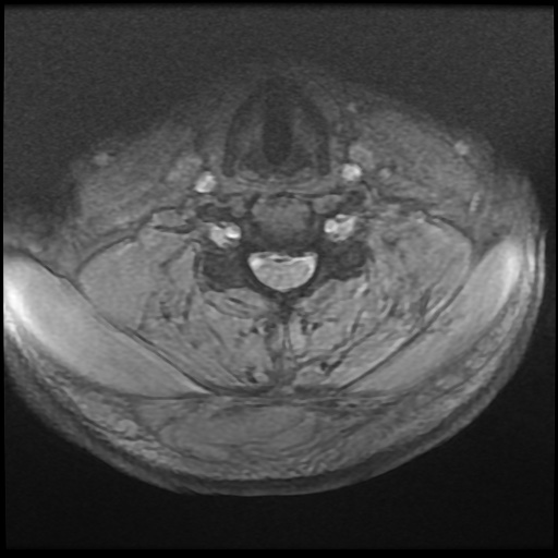 Cervical disc extrusion (Radiopaedia 59074-66364 F 34).jpg