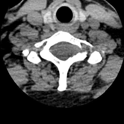 File:Cervical spinal neurofibroma in a patient with NF1 (Radiopaedia 58344-65464 Axial non-contrast 60).jpg