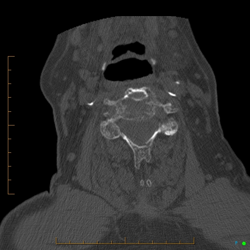 File:Cervical spine fracture - ankylosing spondylitis (Radiopaedia 76835-88706 Axial bone window 110).jpg