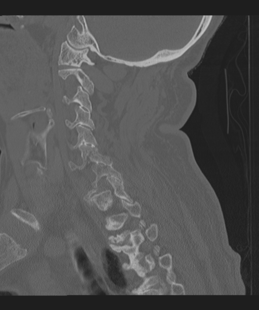 Cervical spine fracture in the setting of ankylosis (Radiopaedia 37038-38715 Sagittal bone window 53).png