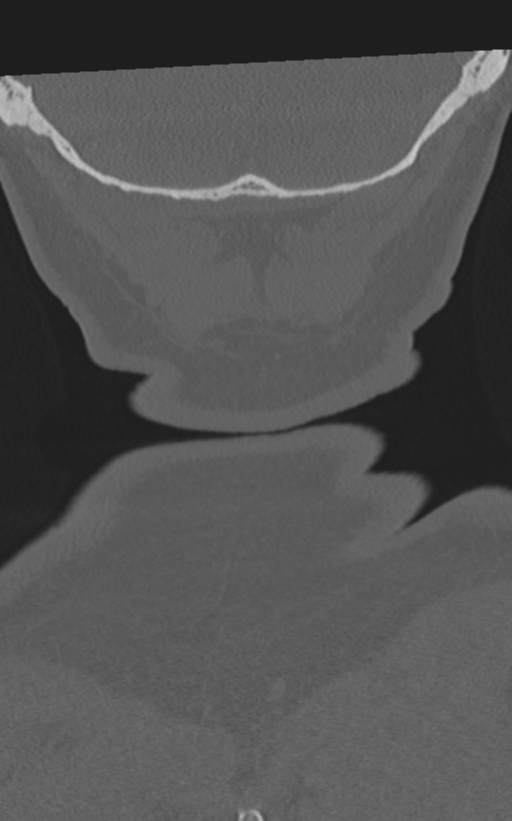 Cervical spine fractures with vertebral artery dissection (Radiopaedia 53296-59268 Coronal bone window 73).png
