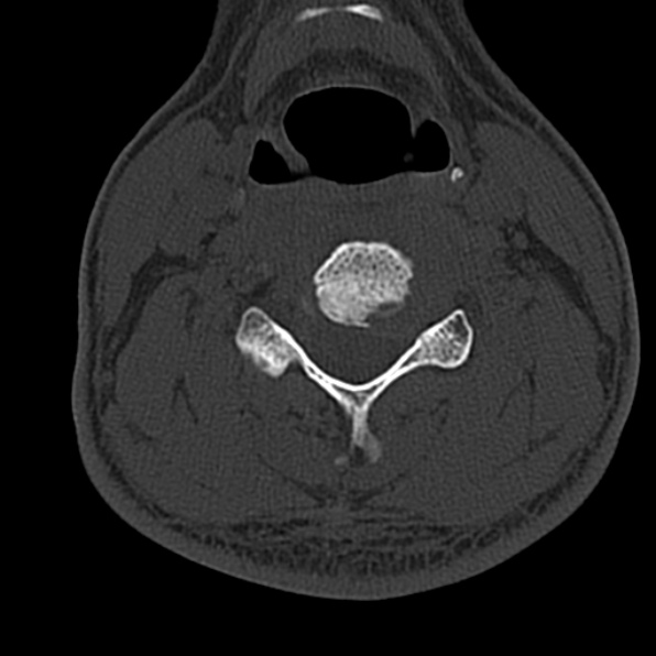 Cervical spondylodiscitis (Radiopaedia 28057-29489 Axial bone window 43).jpg