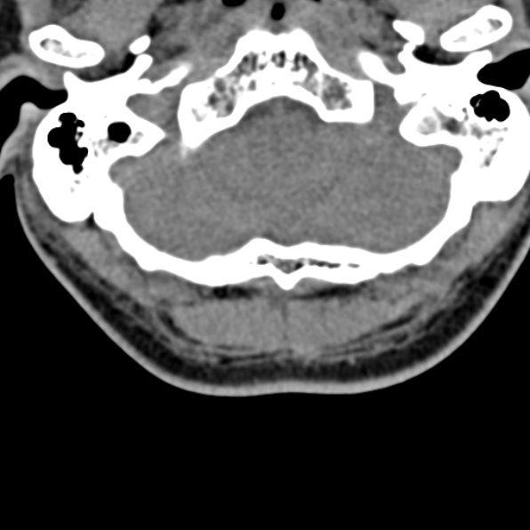 Cervical spondylodiscitis (Radiopaedia 28057-29489 Axial non-contrast 8).jpg