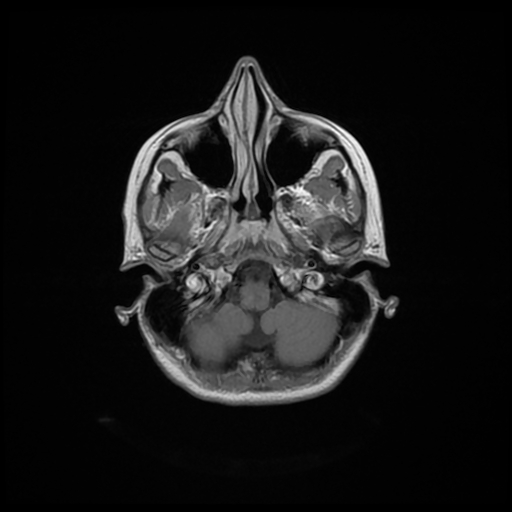 File:Cervical spondylodiscitis and calvarial hemangioma (Radiopaedia 64317-73103 Axial T1 C+ 26).jpg