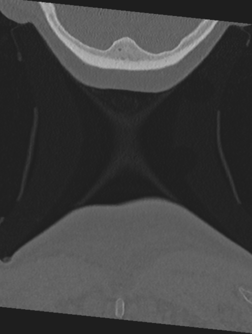 Cervical spondylolysis (Radiopaedia 49616-54811 Coronal bone window 75).png