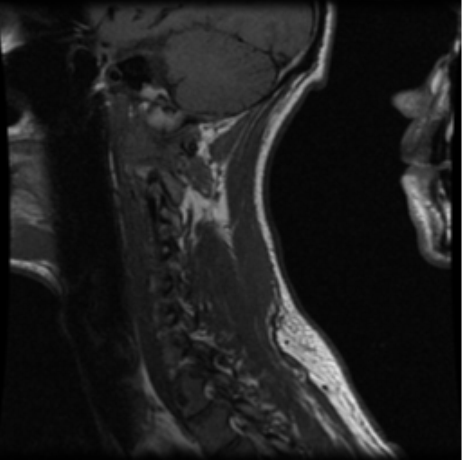 File:Cervical vertebrae metastasis (Radiopaedia 78814-91667 Sagittal T1 10).png