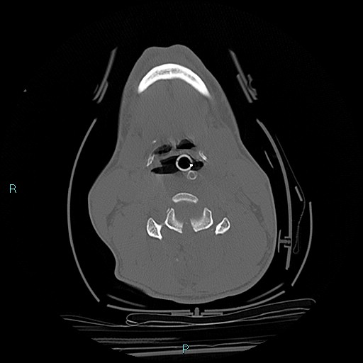 File:Cervical vertebral burst fracture (Radiopaedia 37420-39258 Axial bone window 36).jpg