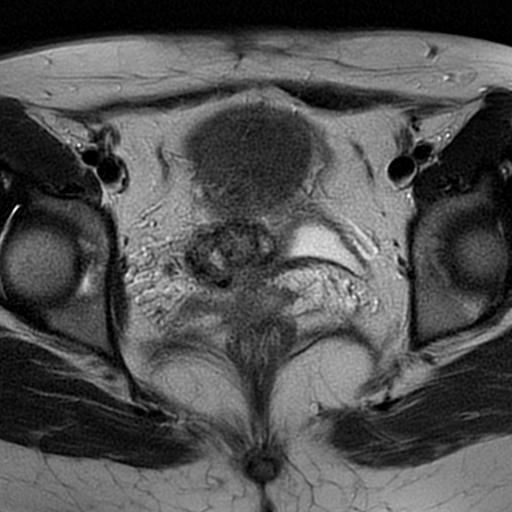 File:Cesarean scar ectopic pregnancy (Radiopaedia 77286-89362 Axial T2 25).jpg