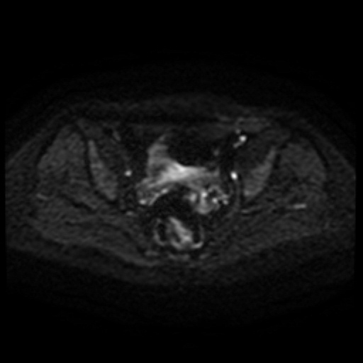 File:Cesarian section scar endometriosis (Radiopaedia 66520-75799 Axial DWI 63).jpg